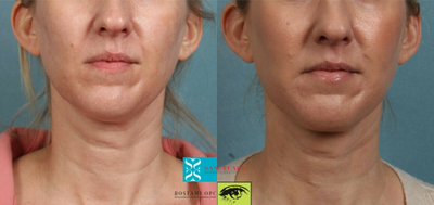 Nonsurgical Neck Lift before and after photo