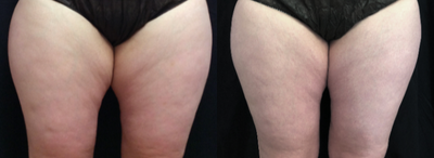 truSculpt before and after photo
