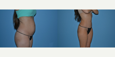 Tummy Tuck before and after photo