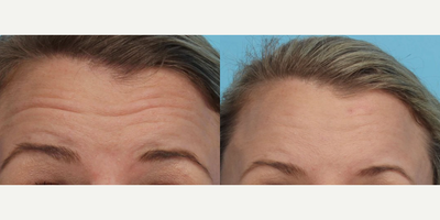 Botox before and after photo