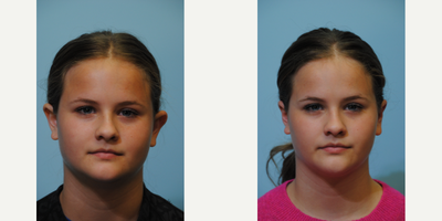 Ear Surgery before and after photo