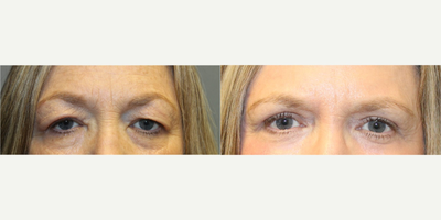 Eyelid Surgery before and after photo