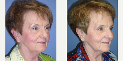 Eyelid Surgery before and after photo