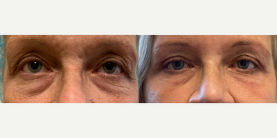 Laser Resurfacing before and after photo