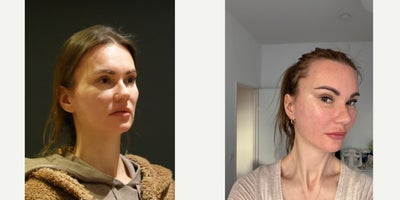 Brow Lift before and after photo