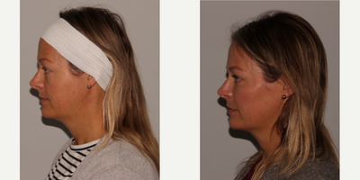 Chin Filler before and after photo