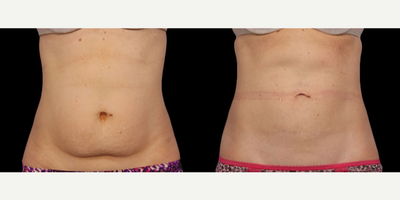 CoolSculpting before and after photo