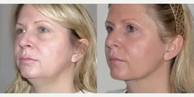 Facelift before and after photo