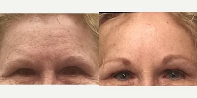 Brow Lift before and after photo