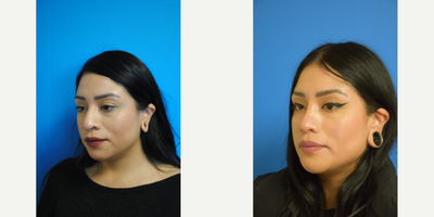 Chin Implant before and after photo