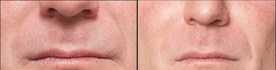 Restylane before and after photo