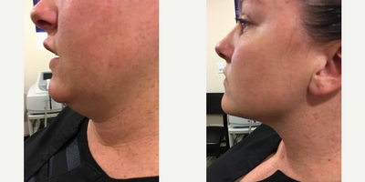 Kybella before and after photo