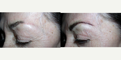 Permanent Makeup before and after photo