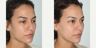 Rhinoplasty before and after photo