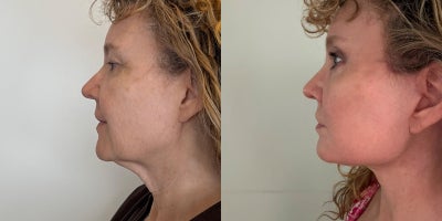 Deep Plane Facelift before and after photo