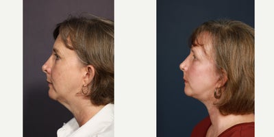 Facial Fat Transfer before and after photo