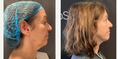 Smart Lipo before and after photo