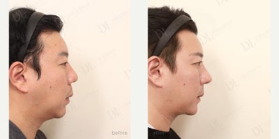 Canthoplasty before and after photo