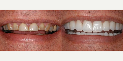 Dental Crown before and after photo