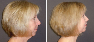 Facelift before and after photo
