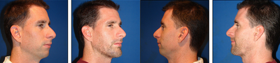 Neck Lift before and after photo