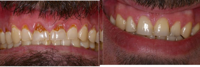 Tooth Repair before and after photo
