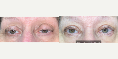 Eyelid Surgery before and after photo