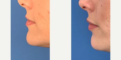 Juvederm before and after photo