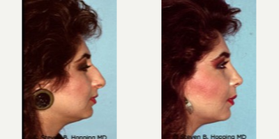 Rhinoplasty before and after photo
