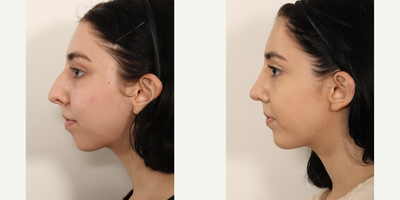 Rhinoplasty before and after photo