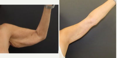 Arm Lift before and after photo