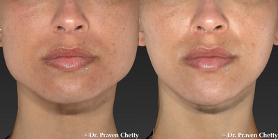 Botox before and after photo