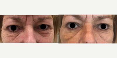 Botox before and after photo