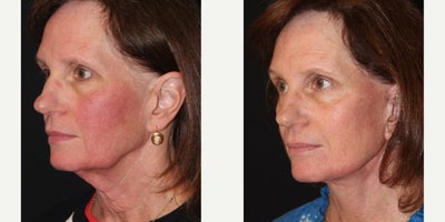 Facelift before and after photo