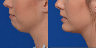 Genioplasty before and after photo
