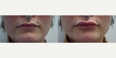 Juvederm before and after photo