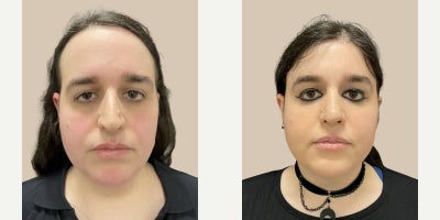 Liposuction before and after photo