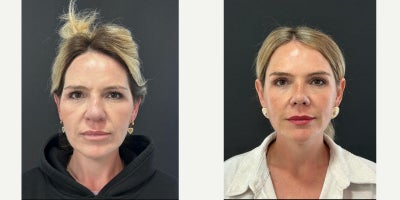 Rhinoplasty before and after photo