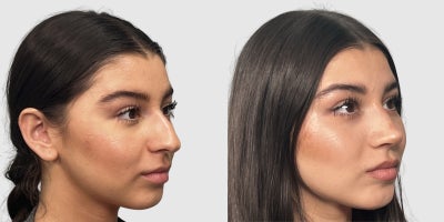 Rhinoplasty before and after photo