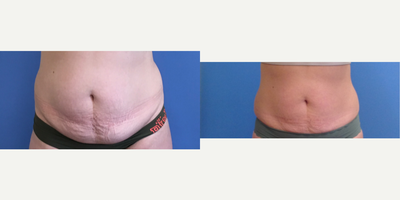 SculpSure before and after photo