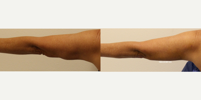 ThermiTight before and after photo