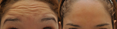 Botox before and after photo