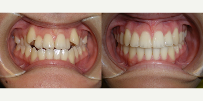 Braces before and after photo