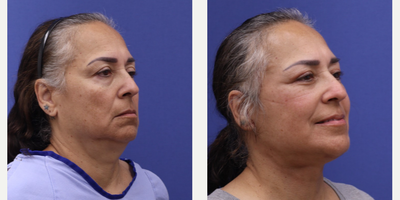 Buccal Fat Removal before and after photo
