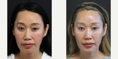 Facial Fat Transfer before and after photo