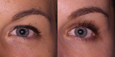 Latisse before and after photo
