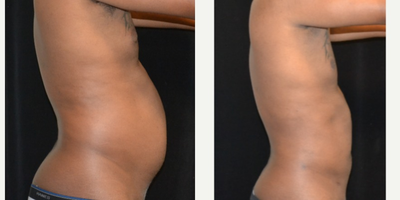 Liposuction before and after photo