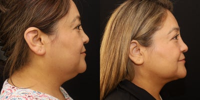 Liposuction before and after photo