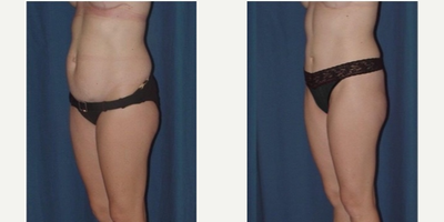 Tummy Tuck before and after photo