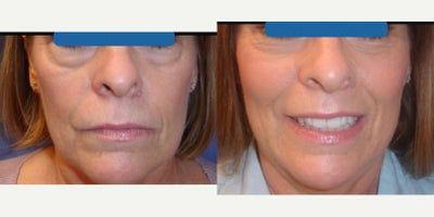 before and after image